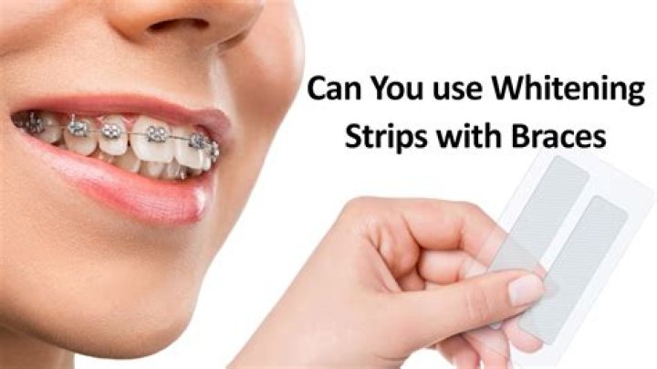 Can you use whitening strips with braces?