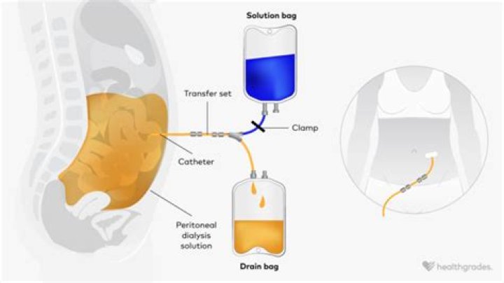 Does peritoneal dialysis remove excess fluid?