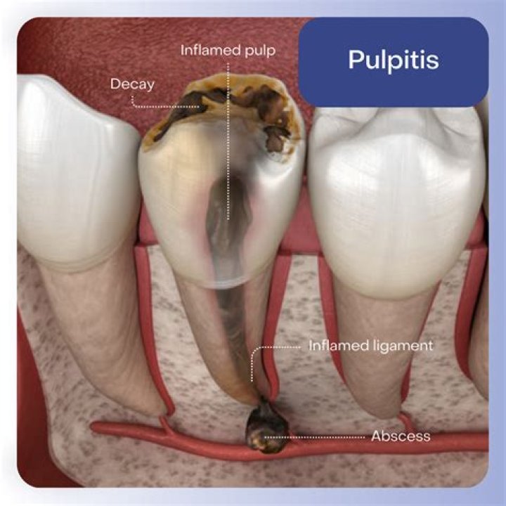 How to heal pulpitis naturally?